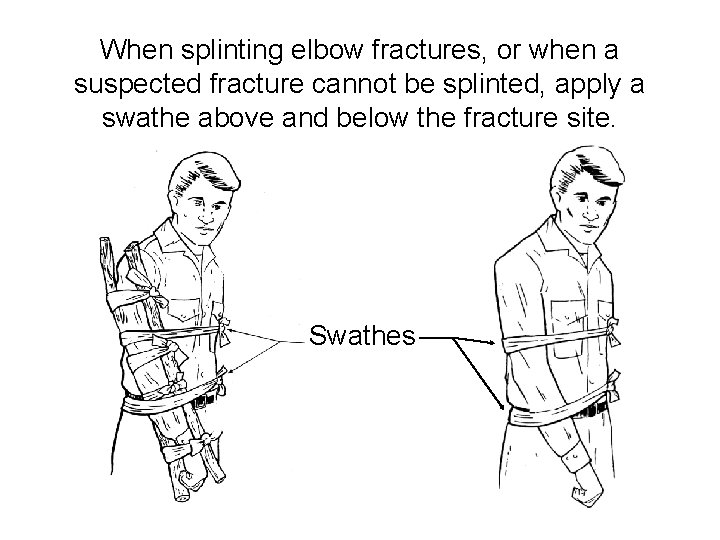 When splinting elbow fractures, or when a suspected fracture cannot be splinted, apply a
