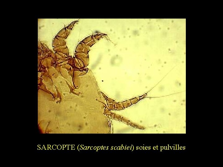 SARCOPTE (Sarcoptes scabiei) soies et pulvilles 