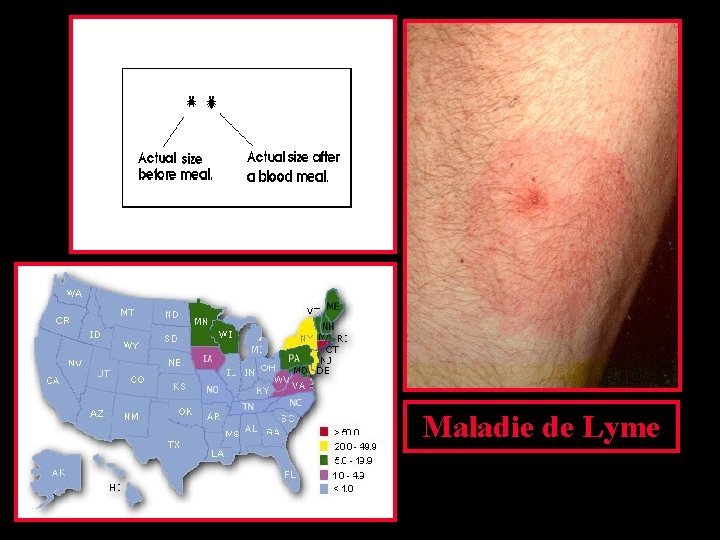 Maladie de Lyme 