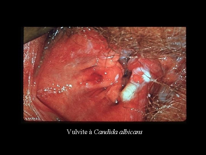 Vulvite à Candida albicans 