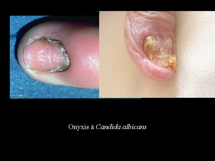 Onyxis à Candida albicans 