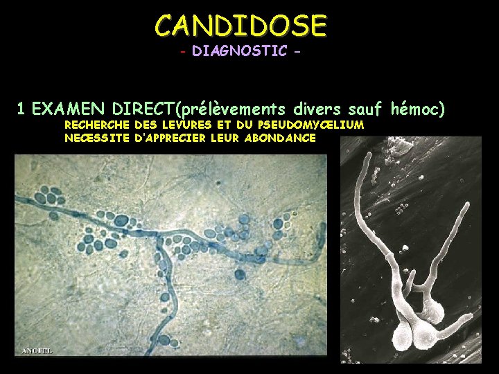 CANDIDOSE - DIAGNOSTIC - 1 EXAMEN DIRECT(prélèvements divers sauf hémoc) RECHERCHE DES LEVURES ET