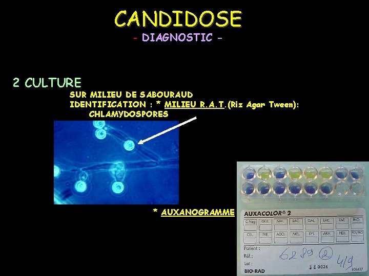 CANDIDOSE - DIAGNOSTIC - 2 CULTURE SUR MILIEU DE SABOURAUD IDENTIFICATION : * MILIEU