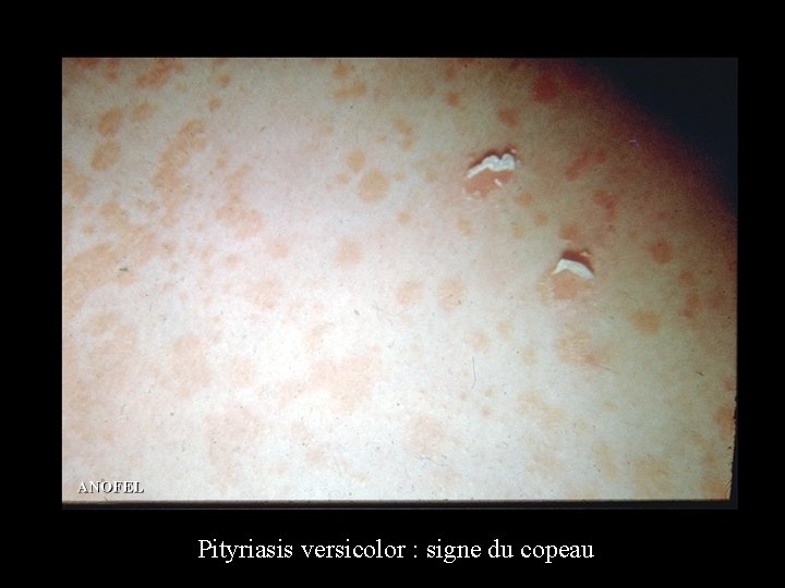 Pityriasis versicolor : signe du copeau 