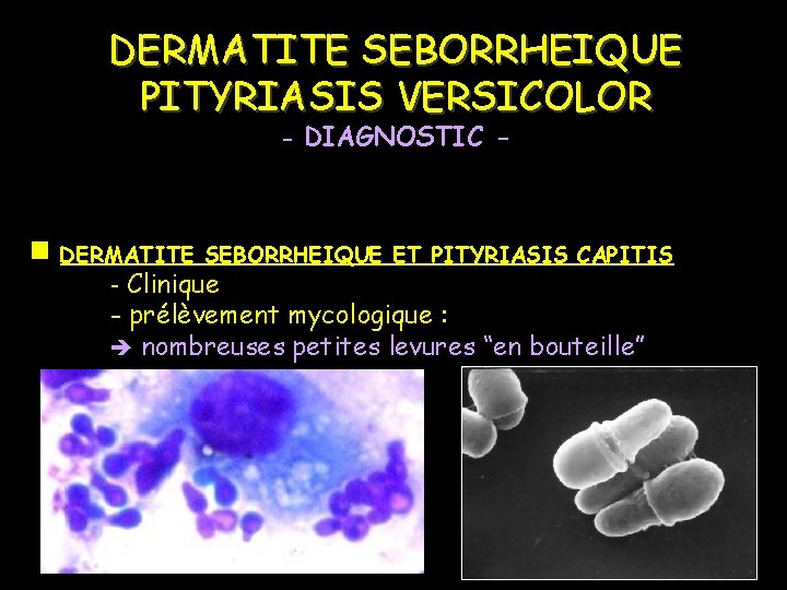 DERMATITE SEBORRHEIQUE PITYRIASIS VERSICOLOR - DIAGNOSTIC - DERMATITE SEBORRHEIQUE ET PITYRIASIS CAPITIS - Clinique