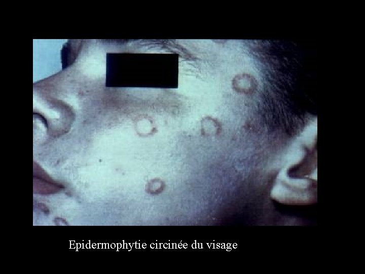 Epidermophytie circinée du visage 