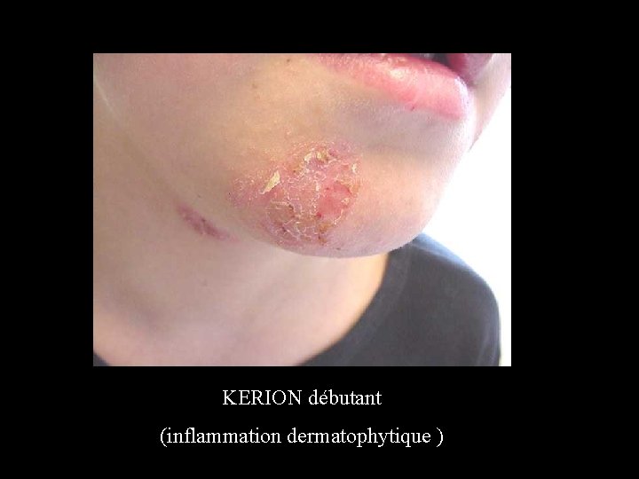 KERION débutant (inflammation dermatophytique ) 