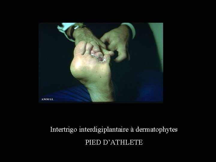 Intertrigo interdigiplantaire à dermatophytes PIED D’ATHLETE 