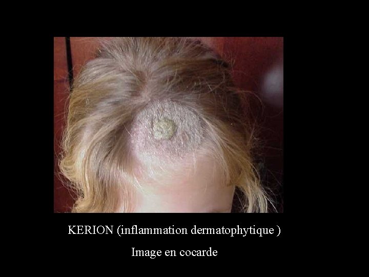 KERION (inflammation dermatophytique ) Image en cocarde 