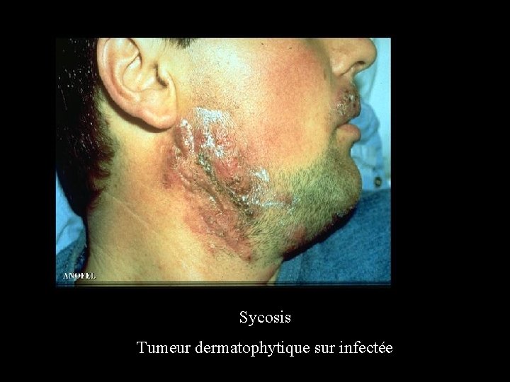 Sycosis Tumeur dermatophytique sur infectée 