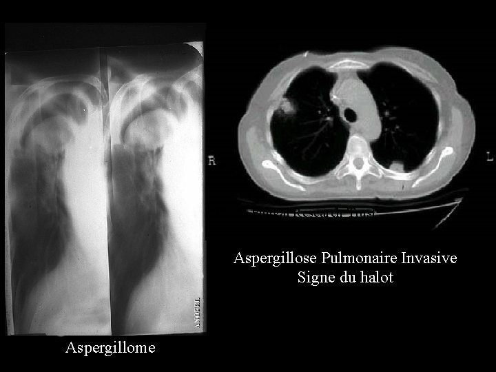 Photo Fungal Research Trust Aspergillose Pulmonaire Invasive Signe du halot Aspergillome 