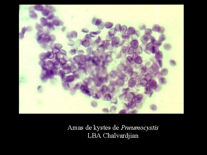 Amas de kystes de Pneumocystis LBA Chalvardjian 