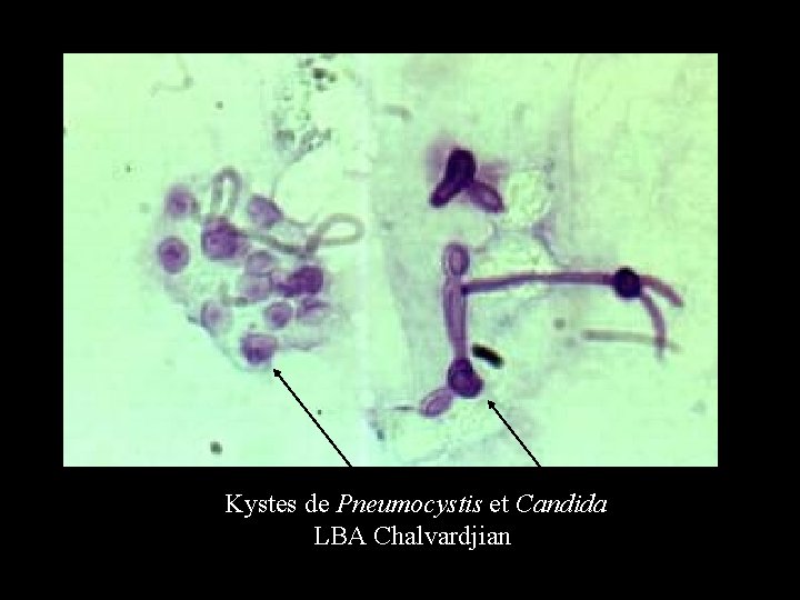 Kystes de Pneumocystis et Candida LBA Chalvardjian 