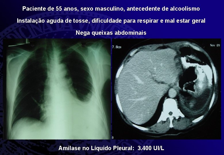 Paciente de 55 anos, sexo masculino, antecedente de alcoolismo Instalação aguda de tosse, dificuldade