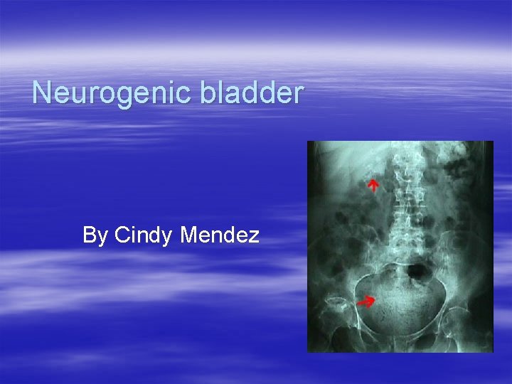 Neurogenic bladder By Cindy Mendez 