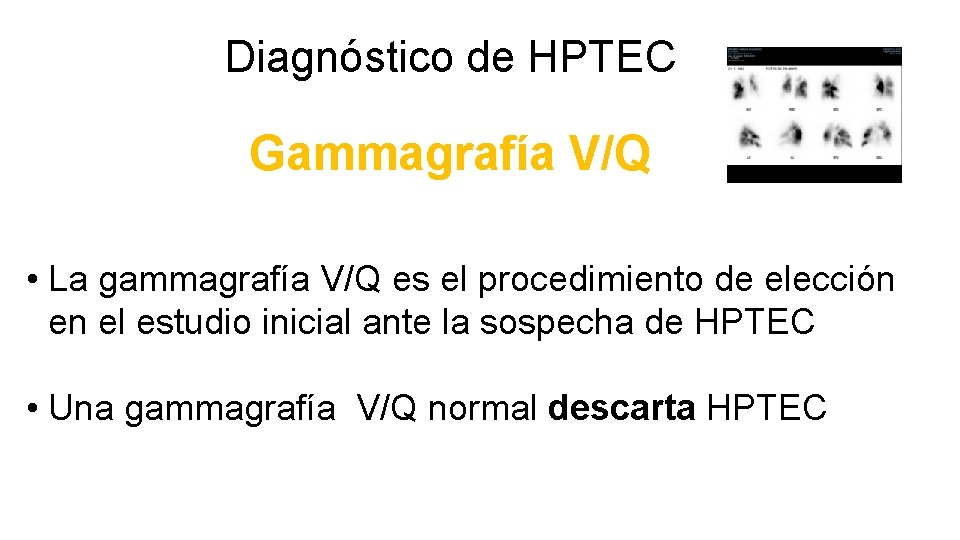 Diagnóstico de HPTEC Gammagrafía V/Q • La gammagrafía V/Q es el procedimiento de elección