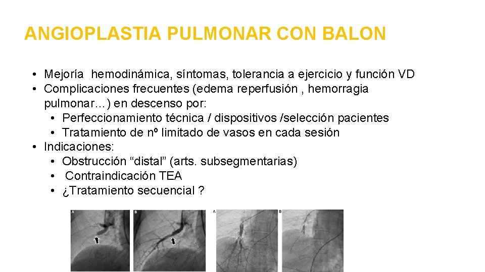 ANGIOPLASTIA PULMONAR CON BALON • Mejoría hemodinámica, síntomas, tolerancia a ejercicio y función VD