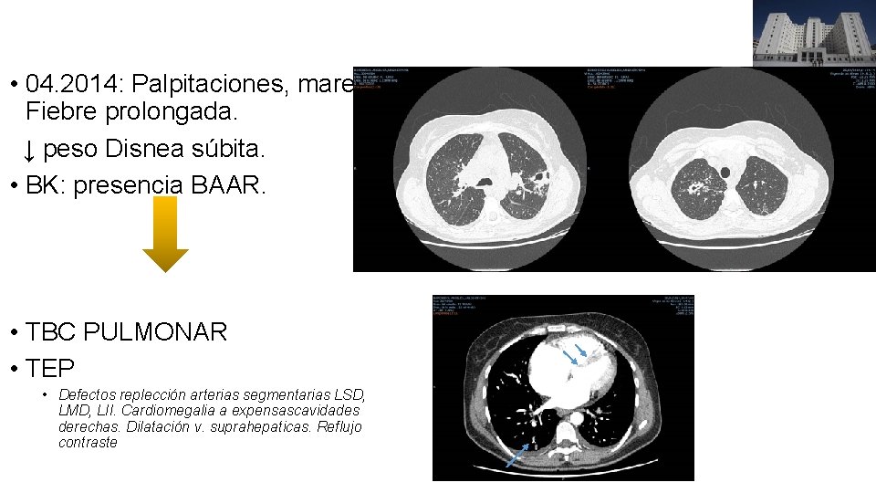  • 04. 2014: Palpitaciones, mareo. Fiebre prolongada. ↓ peso Disnea súbita. • BK: