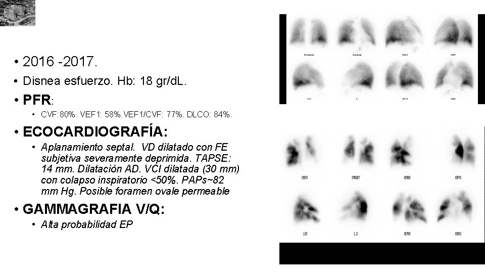  • 2016 -2017. • Disnea esfuerzo. Hb: 18 gr/d. L. • PFR: •