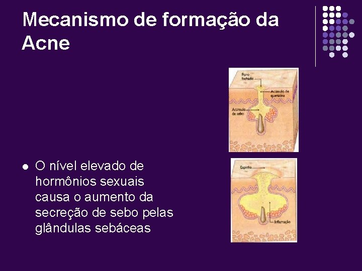 Mecanismo de formação da Acne l O nível elevado de hormônios sexuais causa o