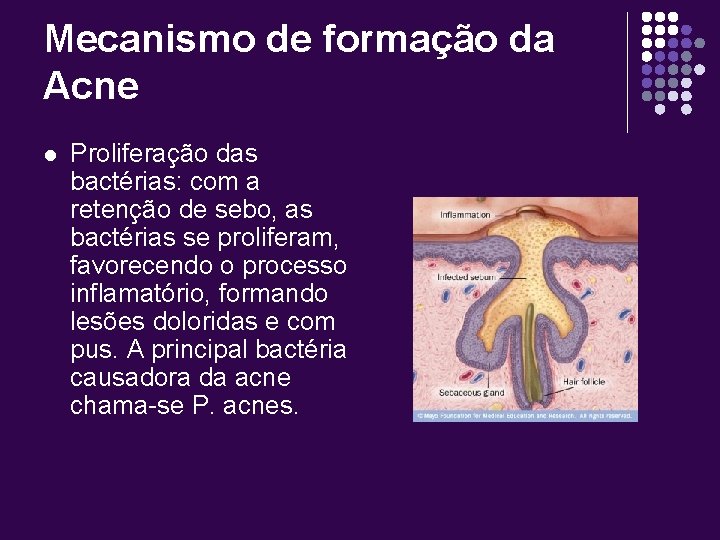 Mecanismo de formação da Acne l Proliferação das bactérias: com a retenção de sebo,