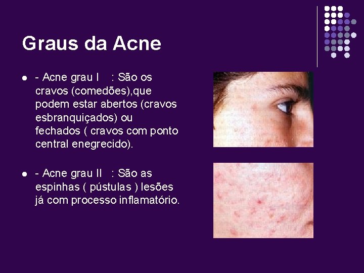 Graus da Acne l - Acne grau I : São os cravos (comedões), que