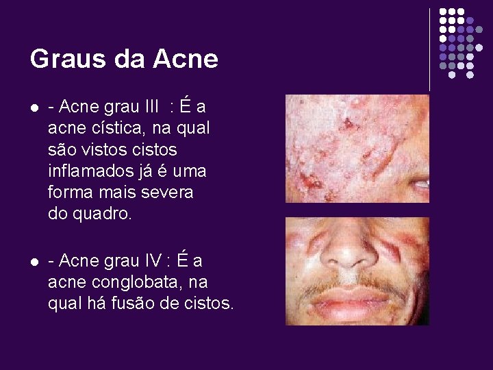 Graus da Acne l - Acne grau III : É a acne cística, na