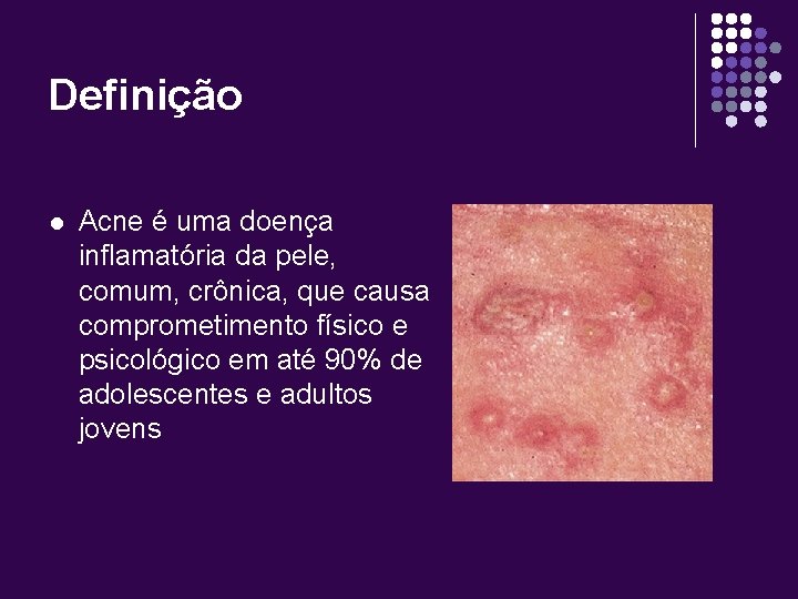 Definição l Acne é uma doença inflamatória da pele, comum, crônica, que causa comprometimento