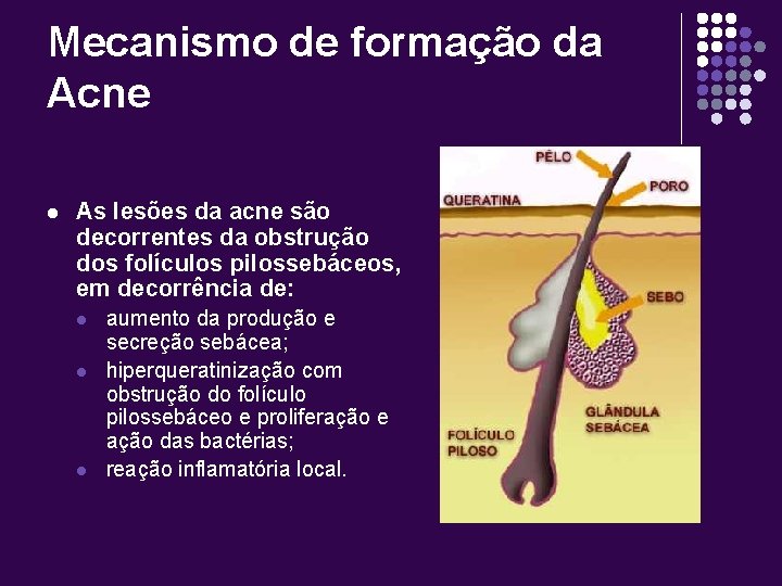 Mecanismo de formação da Acne l As lesões da acne são decorrentes da obstrução