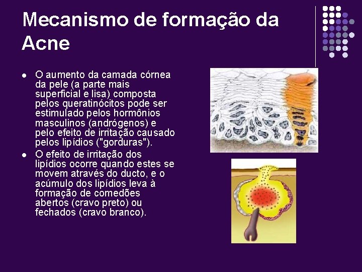 Mecanismo de formação da Acne l l O aumento da camada córnea da pele