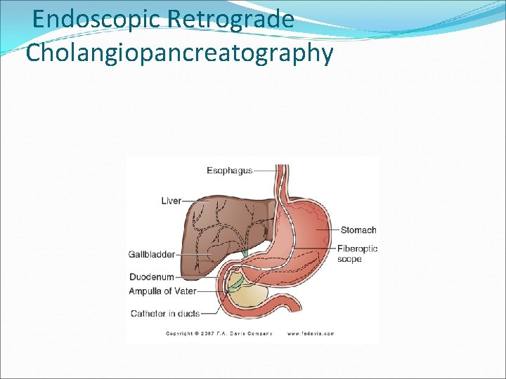 Endoscopic Retrograde Cholangiopancreatography 