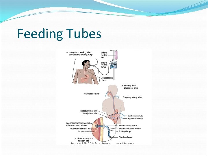 Feeding Tubes 