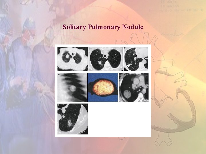 Solitary Pulmonary Nodule 