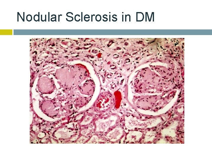 Nodular Sclerosis in DM 