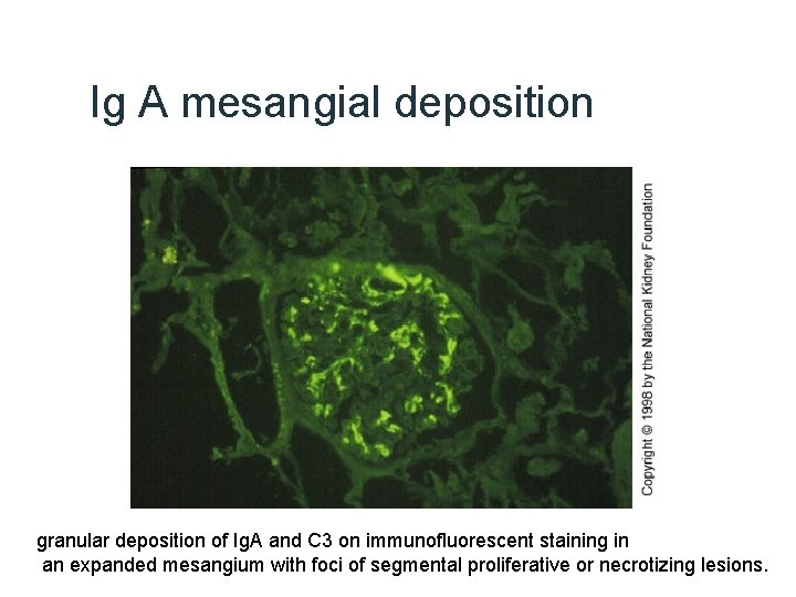 Ig A mesangial deposition granular deposition of Ig. A and C 3 on immunofluorescent