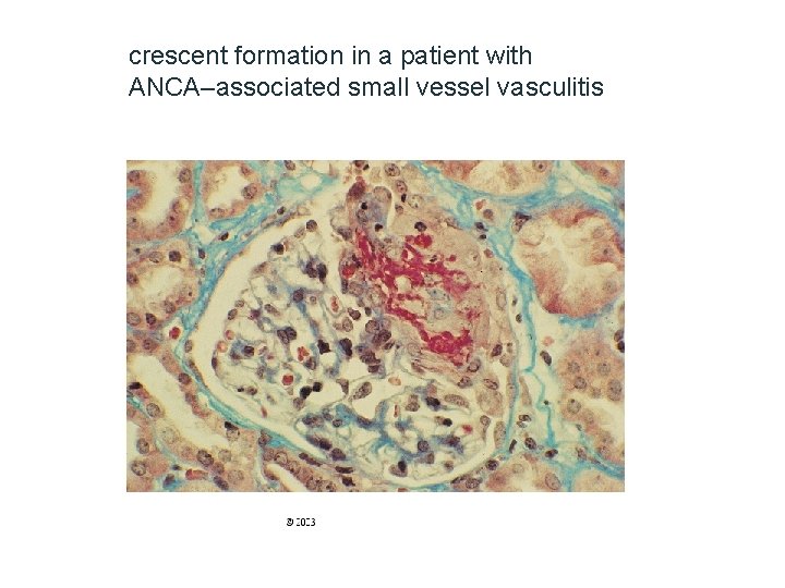 crescent formation in a patient with ANCA–associated small vessel vasculitis 