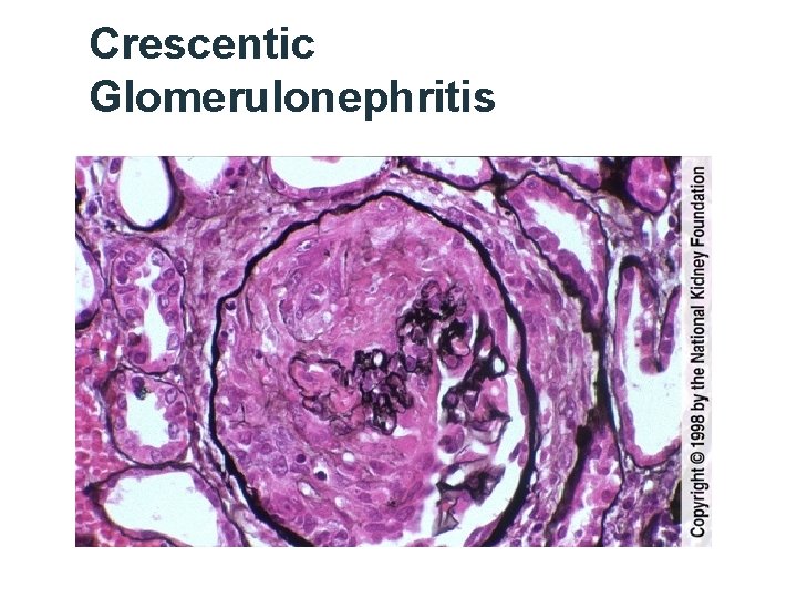 Crescentic Glomerulonephritis 