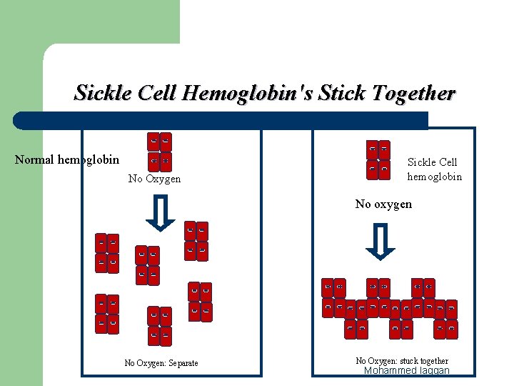 Sickle Cell Hemoglobin's Stick Together Normal hemoglobin No Oxygen Sickle Cell hemoglobin No oxygen