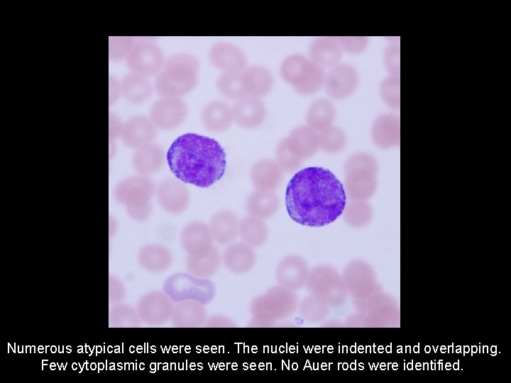 Numerous atypical cells were seen. The nuclei were indented and overlapping. Few cytoplasmic granules