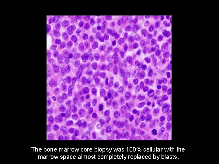 The bone marrow core biopsy was 100% cellular with the marrow space almost completely