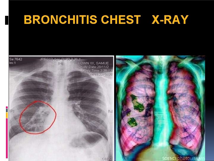 BRONCHITIS CHEST X-RAY 