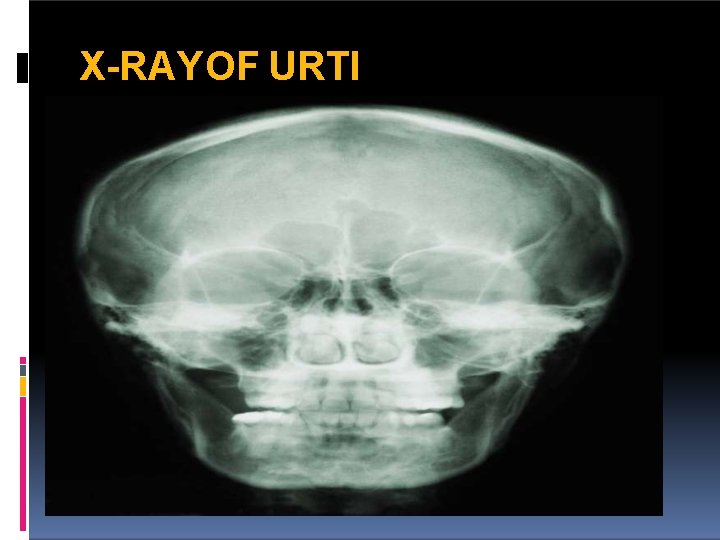 X-RAYOF URTI 