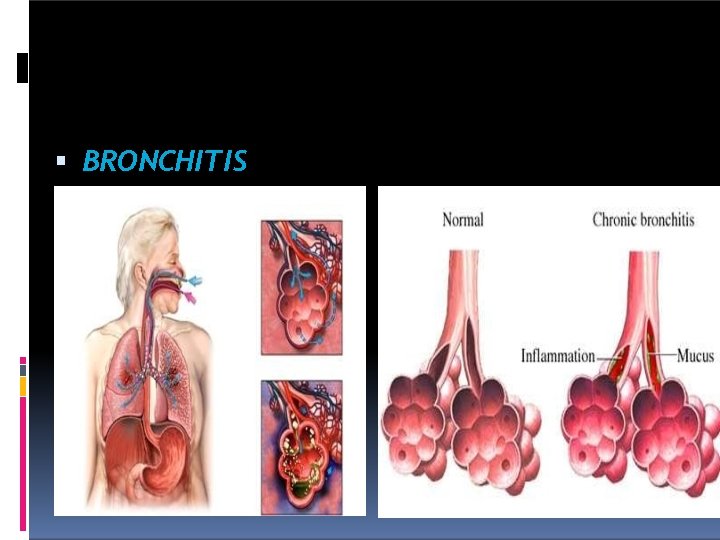  BRONCHITIS 