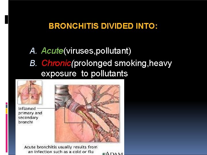 BRONCHITIS DIVIDED INTO: A. Acute(viruses, pollutant) B. Chronic(prolonged smoking, heavy exposure to pollutants 