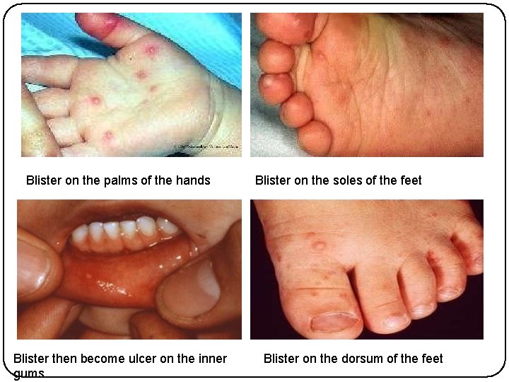 Blister on the palms of the hands Blister then become ulcer on the inner