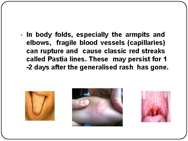  • In body folds, especially the armpits and elbows, fragile blood vessels (capillaries)