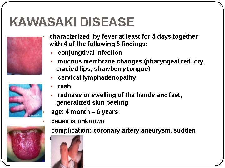 KAWASAKI DISEASE • characterized by fever at least for 5 days together with 4