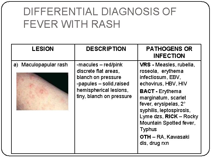 DIFFERENTIAL DIAGNOSIS OF FEVER WITH RASH LESION a) Maculopapular rash DESCRIPTION -macules – red/pink