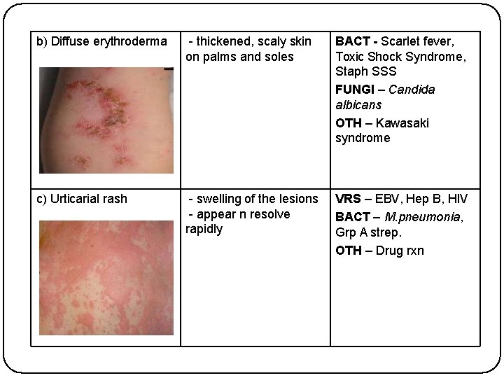 b) Diffuse erythroderma - thickened, scaly skin on palms and soles BACT - Scarlet