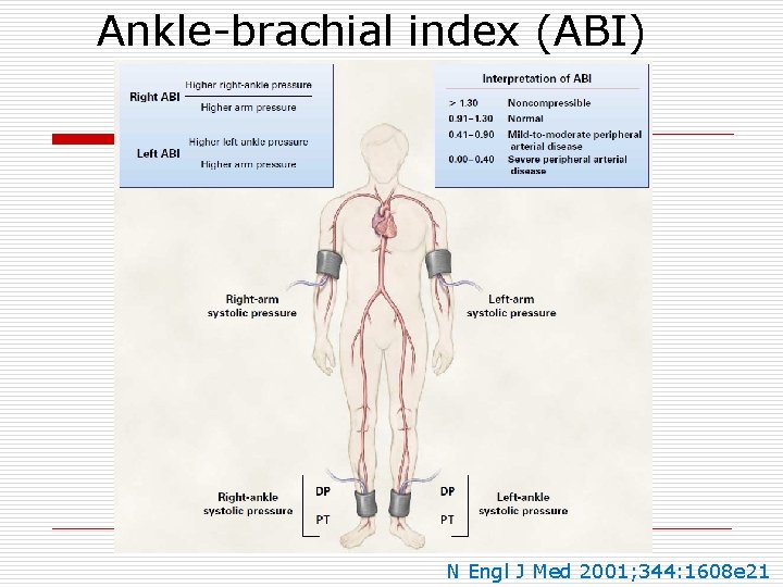 Ankle-brachial index (ABI) N Engl J Med 2001; 344: 1608 e 21 
